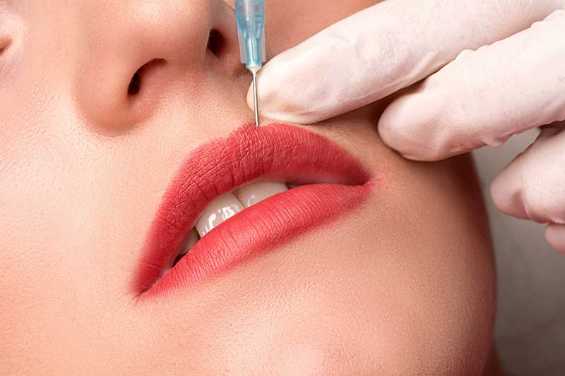 Lip contouring and filling with hyaluronic acid