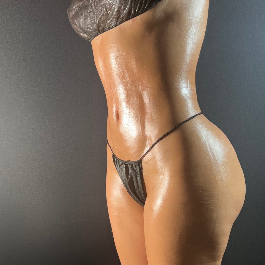 Despues caso Lipovaser HD