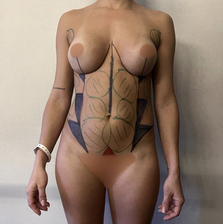 Lipovaser y Renuvion